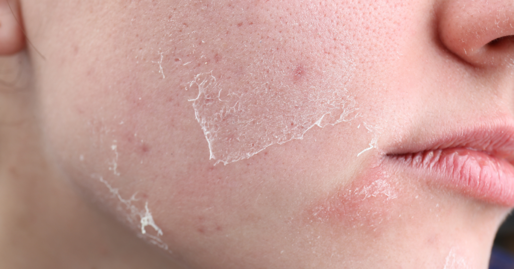 Best Skin Laxity in Vancouver
