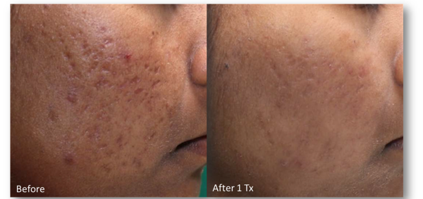 Before and after comparison of acne treatment results, showcasing improved skin texture and reduced scarring after one session.