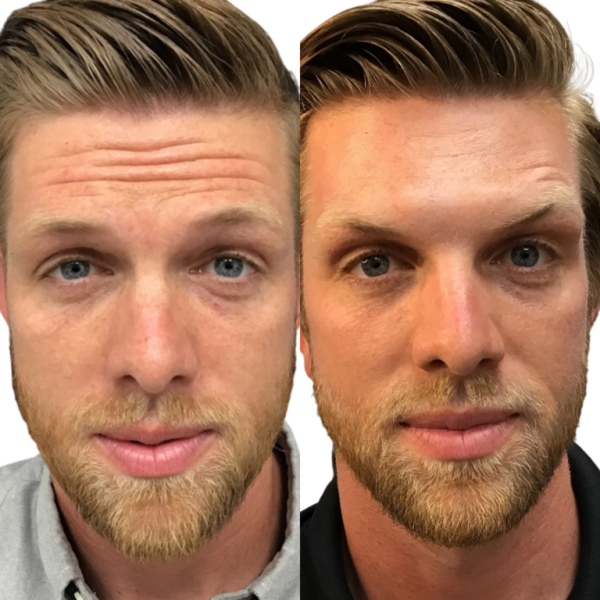 mens botox treatment for frown lines at eterna wellness medical spa in vancouver