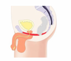 emsella-treatment of urinary incontinence and pelvic floor dysfunction in both women and men