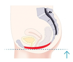 emsella-treatment of urinary incontinence and pelvic floor dysfunction in both women and men