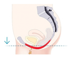 emsella-treatment of urinary incontinence and pelvic floor dysfunction in both women and men