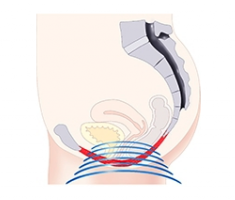 emsella-treatment of urinary incontinence and pelvic floor dysfunction in both women and men