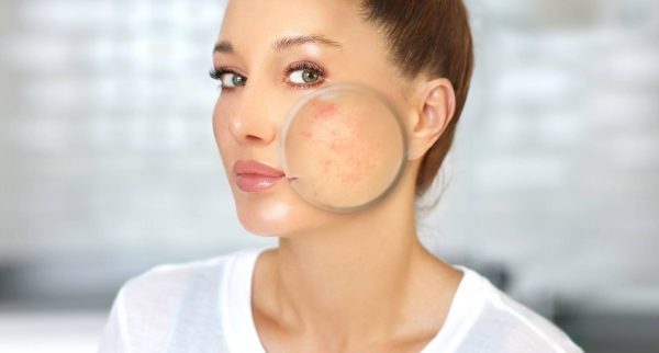 laser treatment for acne scars at eterna wellness medical spa in vancouver