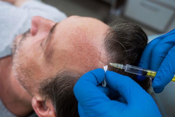 man receiving prp hair treatment at eterna wellnes medical spa in vancouver