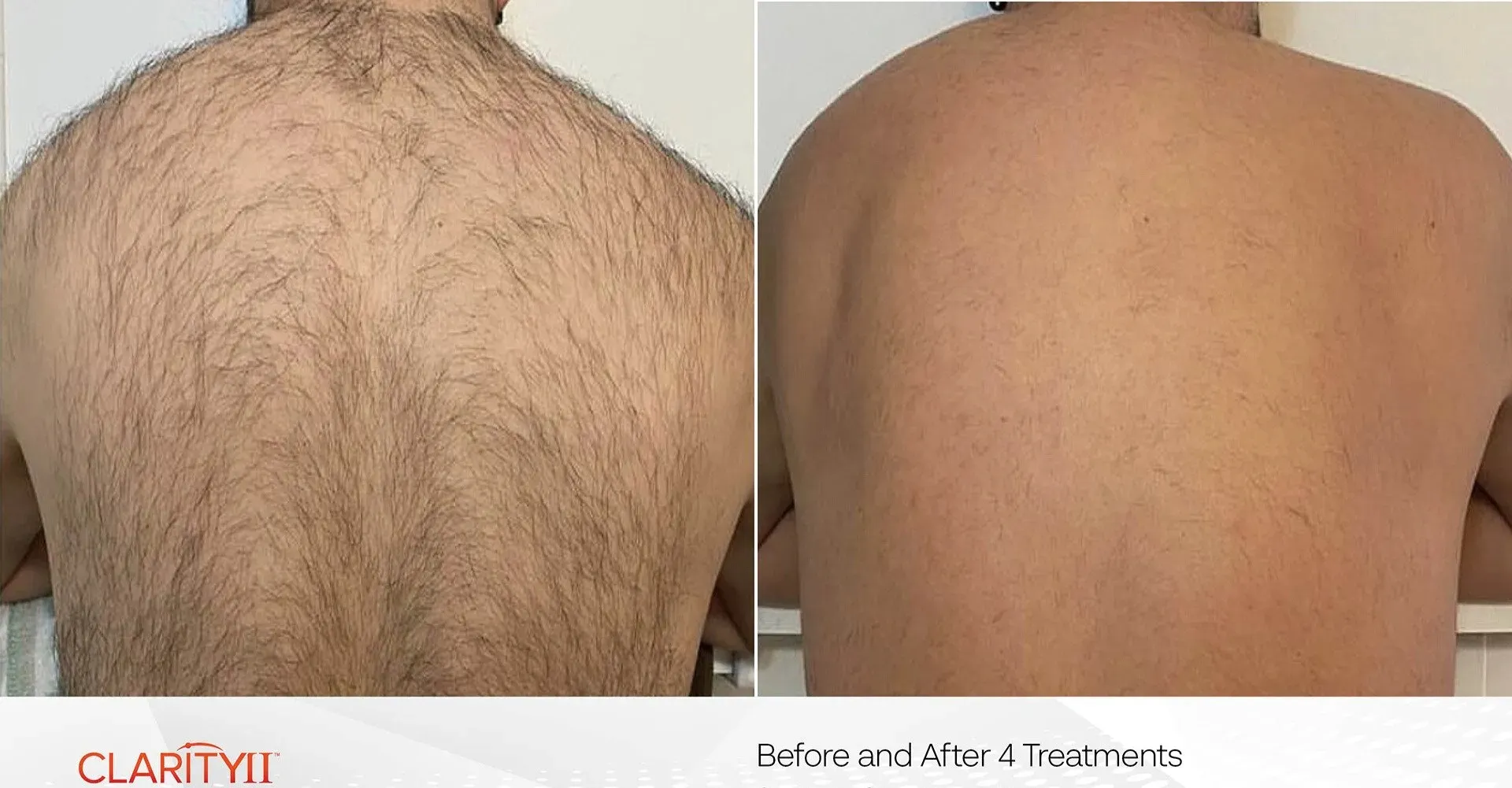 man getting laser hair removal on his back