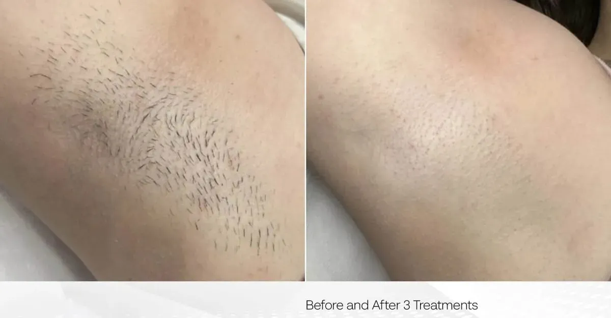 hair removal by laser treatment with clarity 2
