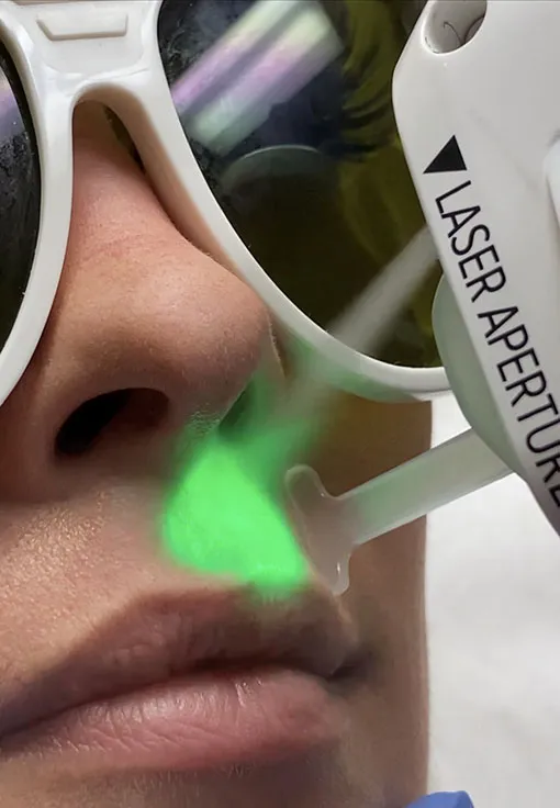 Clarity 2 hair removal medical spa vancouver